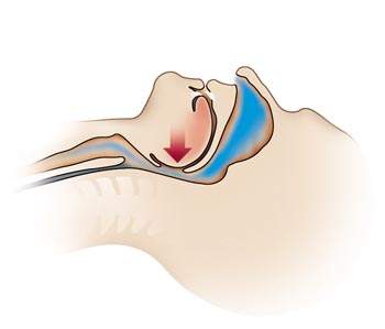Without CPAP: airway partially obstructed illustration